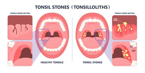 Tonsilloliths Are Stones Located On Or Within The Tonsils That Can