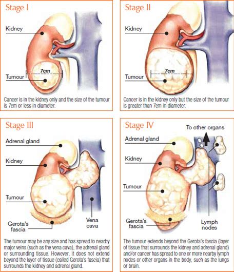 Removing the kidney prolongs survival and may be curative if cancer has not spread. Kidney Cancer, Symptoms, Types, Treatment and Prevention ...