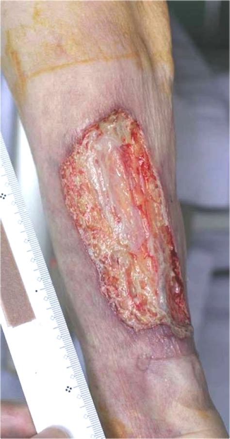 Pyoderma Gangrenosum Pictures Causes Symptoms Treatment And