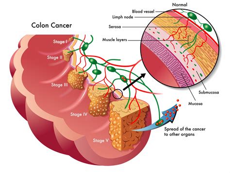 Colorectal Cancer Treatment In Dubai Dubai Hemorrhoids Clinic