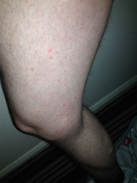 Scabies Or Post Scabies Very Itchy Rash Scabies Forums Patient My XXX