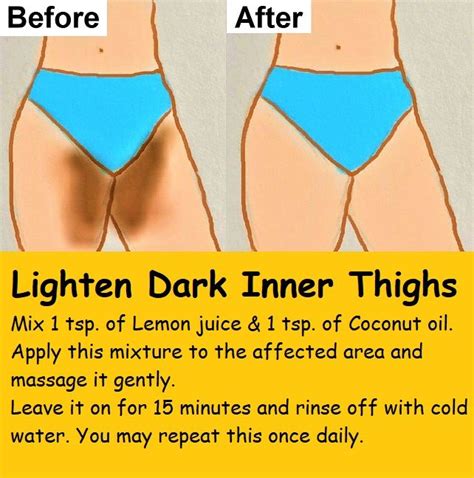 6 home remedies to get rid of dark inner thighs lighten dark inner thighs in 2020 pretty skin