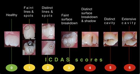 Stages Of Dental Caries
