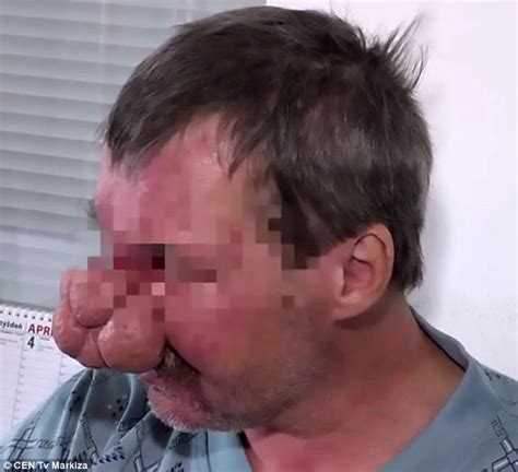 Slovakian Man With A Nose Deformity Finally Has Surgery Daily Mail Online