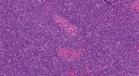 Hpv Associated Squamous Cell Carcinoma Of The Oropharynx Atlas Of