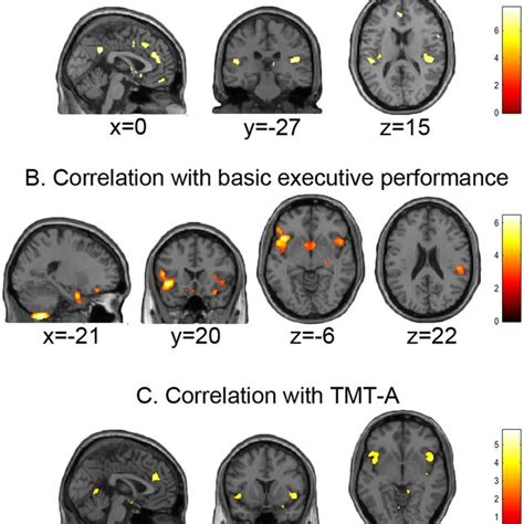 Grey Matter Density Reduction In Auds The Brain Regions In Which Grey