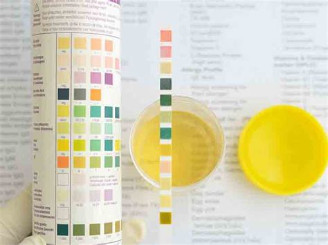 Glucosuria (with normal serum glu), proteinuria, hypophosphatemia, Urine pH Level Test: Purpose, Procedure & Side Effects