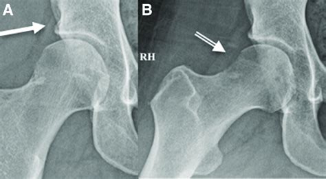 A Right Hip Rh Postoperative Plain Radiograph Anteroposterior View