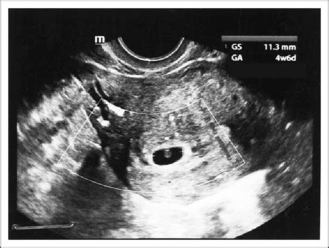 Ultrasonography Showing Gestational Sac Of 4 Weeks And 6 Days