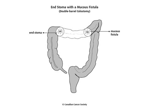 Colostomy And Ileostomy Canadian Cancer Society