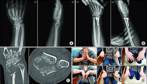 A Radiographs Showing Distal Ulnar Intra Articular Fracture Ao Type