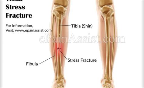 tibial stress fracture symptoms causes treatment rehabilitation otosection