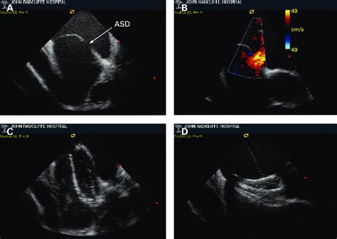 Intracardiac Echocardiography Of A An Atrial Septal Defect Asd With