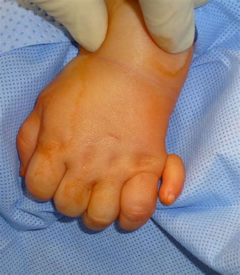Extra Digits Congenital Hand And Arm Differences Washington University In St Louis