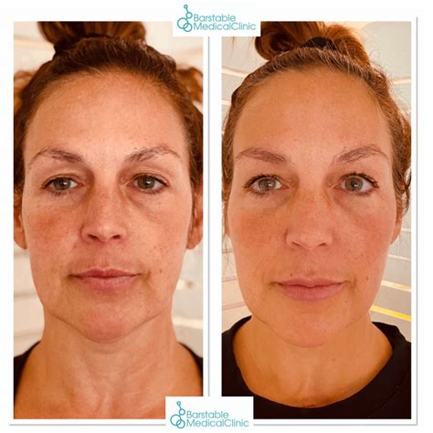 8 Point Facelift Essex Barstable Medical Clinic