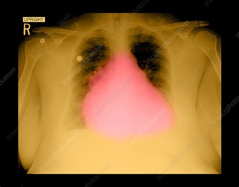 Enlarged Heart On Chest X Ray Stock Image F0312839 Science Photo