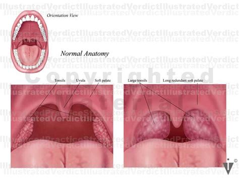 Stock Throat Palate Tonsils — Illustrated Verdict