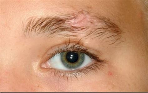 You Can Suffer From Eyebrow Hair Loss Due To Ingrown Hair Bumps Ingrown