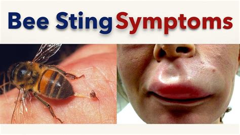Bee Sting Symptoms Youtube
