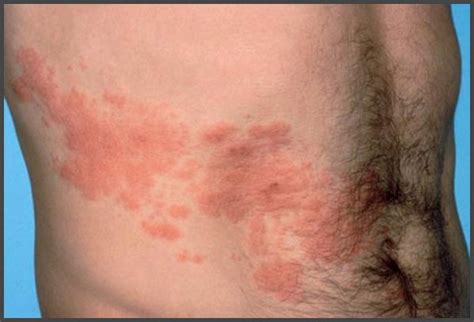 Shingles In Groin Area Pictures Shingles Expert