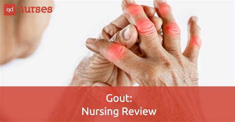 Nclex Review 7 Important Facts About Gout You Should Know As A Nurse