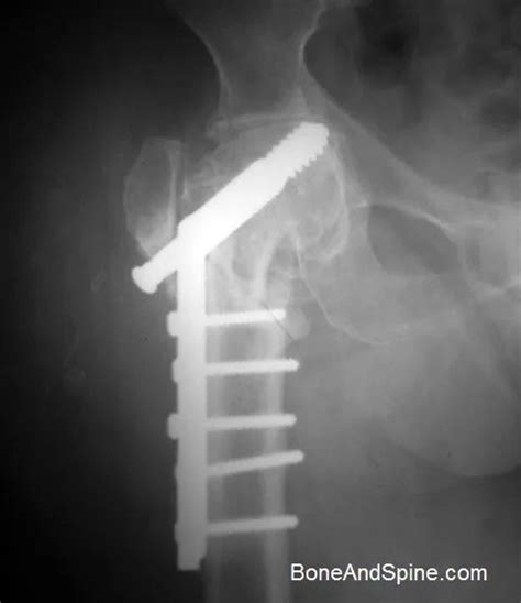 Intertrochanteric Fractures Causes Presentation And Treatment Bone