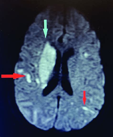 Brain Mri Showing Innumerable Acute To Subacute Embolic Infarcts In