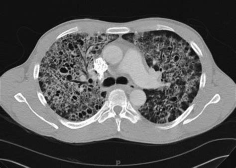 Pneumocystis Carinii Pneumonia Pcp High Resolution Computed