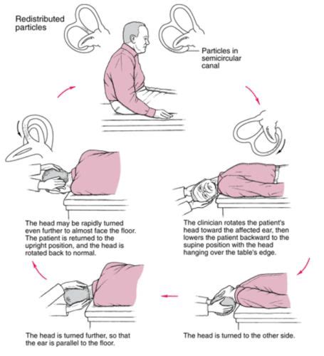 How To Do The Epley Maneuver