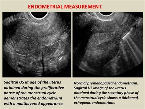 Presentation1pptx Ultrasound Examination Of The Uterus And Ovaries