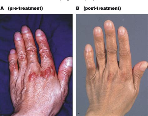 Figure 1 From Erythema Elevatum Diutinum As A Paraneoplastic Syndrome