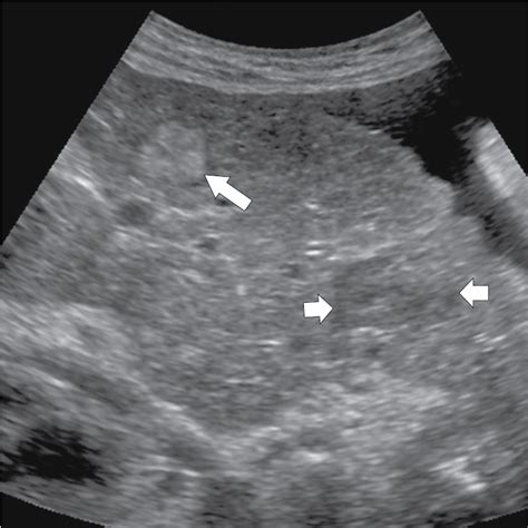 Cirrhosis Ultrasound