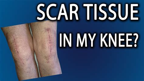 Scar Tissue In Knee How Do I Get Rid Of It Youtube