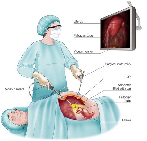 Laparotomy Surgery Exploratory Laparotomy Or Open Laparotomy Procedure
