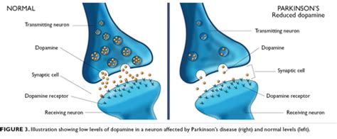 Parkinson disease, degenerative neurological disorder characterized by the onset of tremor, muscle rigidity, slowness in movement, and stooped posture. Parkinson's Disease - Optivida Health