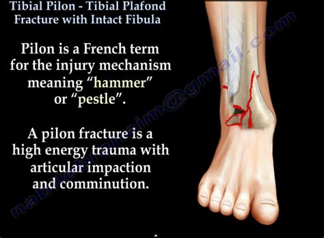 Pilon Tibial Fractures