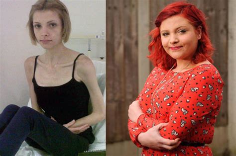 anorexic girl who weighed four stone nearly died after nhs let her down daily star