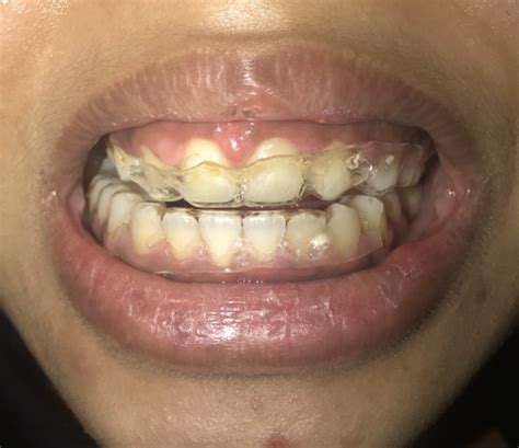 Should I Be Worried About A Small White Bump On My Gums