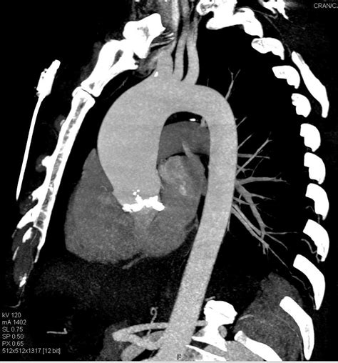 Aortic Valve Calcifications With Aortic Stenosis And Dilated Ascending