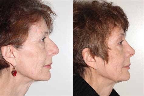 Open Rhinoplasty Before And After Dr Andrew B Denton Vancouver