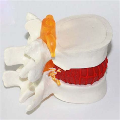 Human Lumbar Disc Herniation Model Demonstration Model Of Lumbar