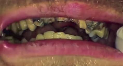 This Guy Hasnt Brushed His Teeth For 20 Years And Omg Its Shocking