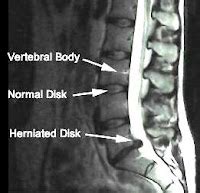 Ct Mri Bulging Discs In Lumbar Spine