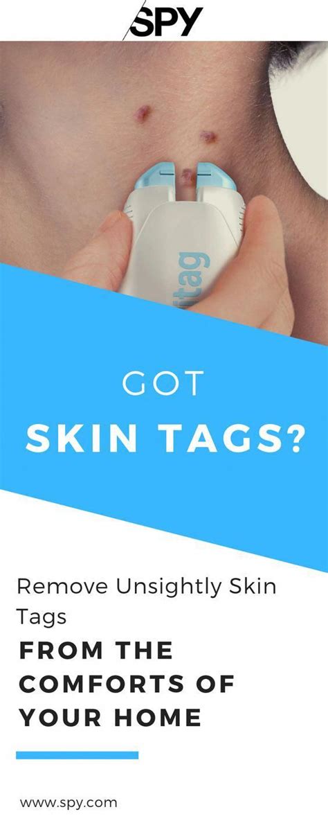 This Is The Only Way You Should Remove Skin Tags According To A