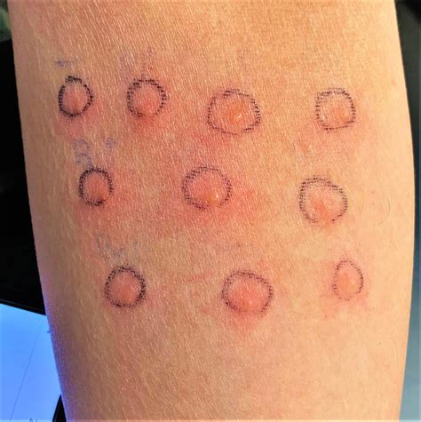 Behcets Disease Diagnosed By Allergy Skin Testing And Positive