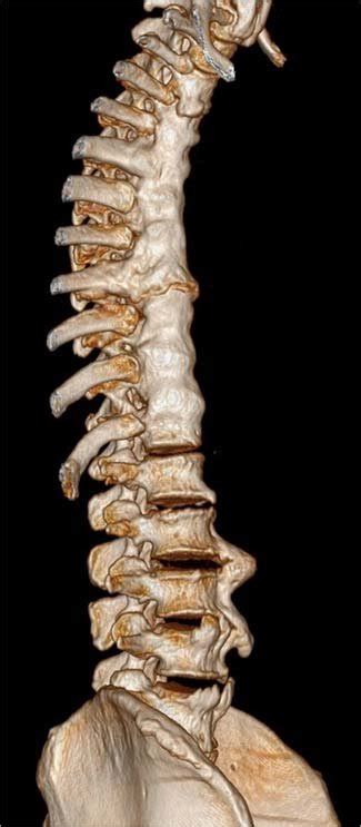 Right Anterolateral View Of The Thoracolumbar Spine On Ct Scan 3d