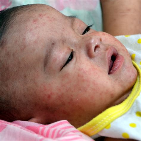 Measles Immunisation Advisory Centre