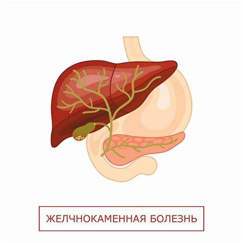 Диета при желчекаменная болезнь симптомы Желчекаменная болезнь - симптомы камней в желчном пузыре, диета, лечение Желчекаменная болезнь - симптомы камней в желчном пузыре, диета, лечение Диета при желчекаменная болезнь симптомы