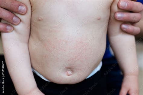 Abdomen Of A One Year Old With Atopic Dermatitis Eczema Showing A