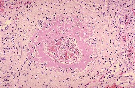 Pathology Outlines Malignant Hypertension And Accelerated Nephrosclerosis